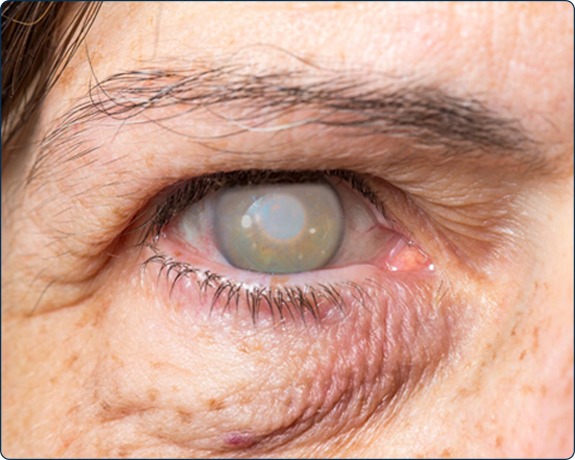 Foto de um olho com catarata