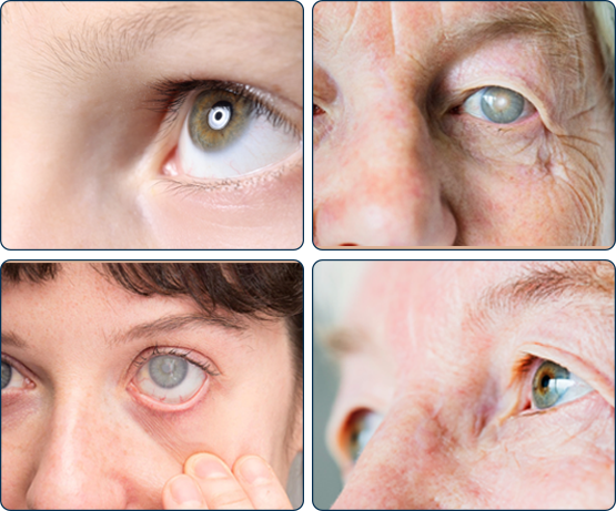 Sequencia de fotos de pessoas com cataratas